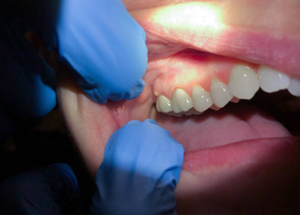 Best Dentist for Tooth Abscess  in Farmland, IN